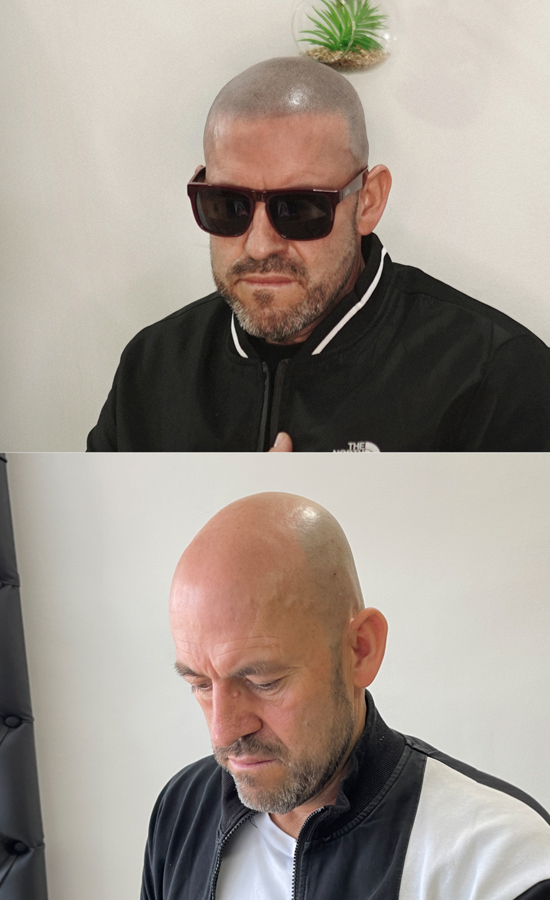 MICROPIGMENTACION CAPILAR EFECTO RAPADO